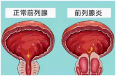 全方位呵护前列腺，前列康热敷贴让每位男性朋友都活力满满